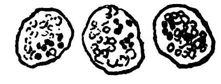 Three of the circles Ronald Ross found in the wall of the mosquito's stomach, each clearly outlined and filled with a cluster of small granules, black as jet.