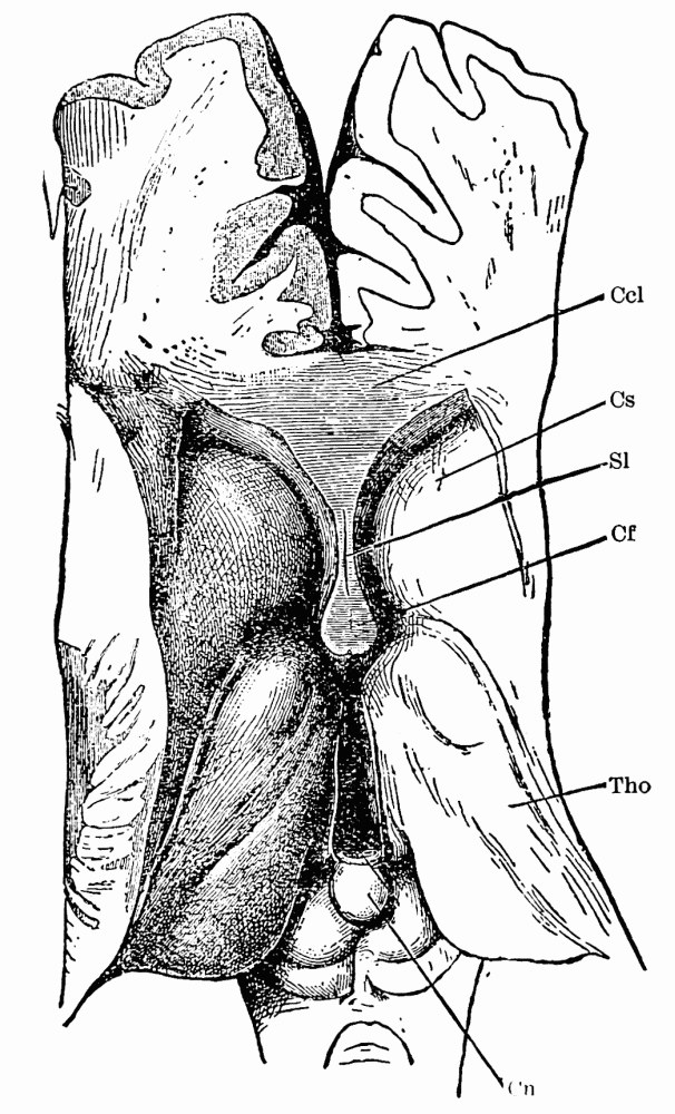 Fig. 36. —Horizontal section of human brain just above the thalami.— Ccl , corpus callosum in section; Cs , corpus striatum; Sl , septum lucidum; Cf , columns of the fornix; Tho , optic thalami; Cn , pineal gland. (After Henle.) — The hemispheres sliced away from above and the ventricles opened: the corpus callosum cut across at the top, the corpus striatum and optic thalamus bulging from each floor, and the pineal gland at the bottom of the midline.
