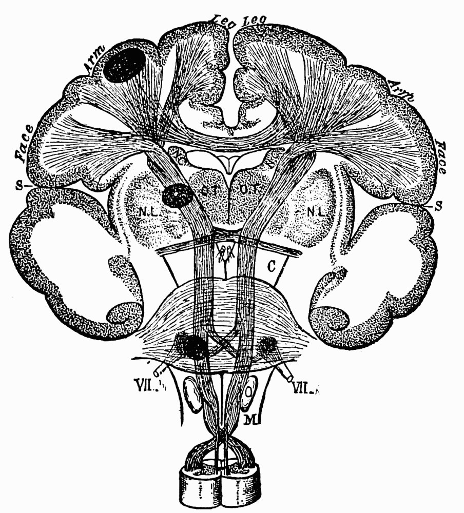 Fig. 43. —Schematic transverse section of the human brain, through the rolandic region. S , fissure of Sylvius; N.C. , nucleus candatus , and N.L. , nucleus lenticularis , of the corpus striatum; O.T. , thalamus; C , crus; M , medulla oblongata; VII , the facial nerves passing out from their nucleus in the region of the pons . The fibres passing between O.T. and N.L. constitute the so-called internal capsule. — A schematic cross-section of the human brain showing motor fibres running down from the leg, arm and face regions of the cortex through the internal capsule to the pons and medulla, with dark ellipses marking hemorrhages or tumors on the left side.