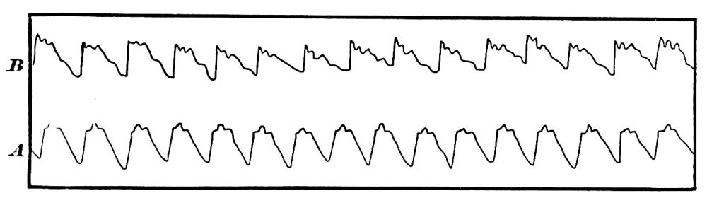 Fig. 50. —Sphygmographic pulse-tracing. A , during intellectual repose; B , during intellectual activity. (Mosso.) — Two rows of pulse-waves, the lower one, A, regular and rounded, the upper one, B, steeper and more jagged, each wave peaking with small notches.