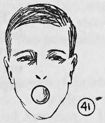 Fig. 41. — A man's face with mouth wide open, showing the white ball resting on his tongue.