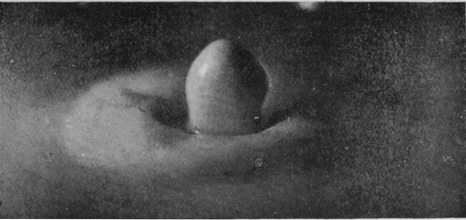 16 0·217 sec. — The column has sunk to a smooth egg-shaped mound sitting in a shallow crater, ringed by a broad raised rim.