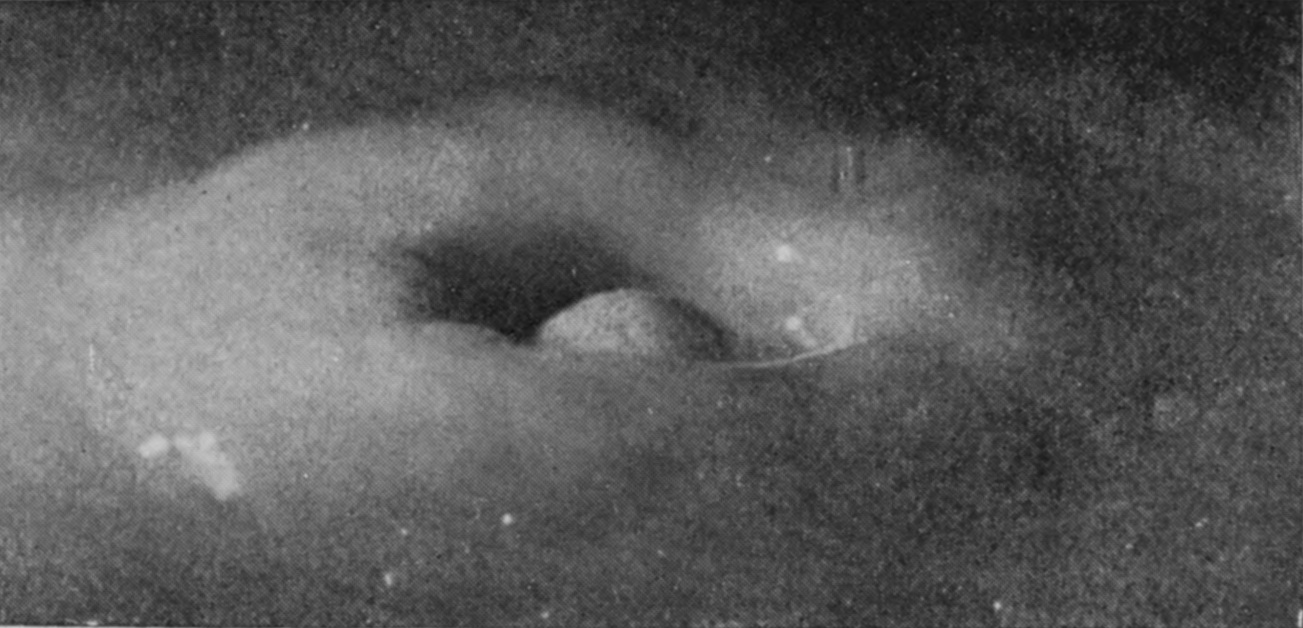 17 0·240 sec. — The column has shrunk to a low dome inside the crater, whose wide ring-shaped rim now fills most of the picture.