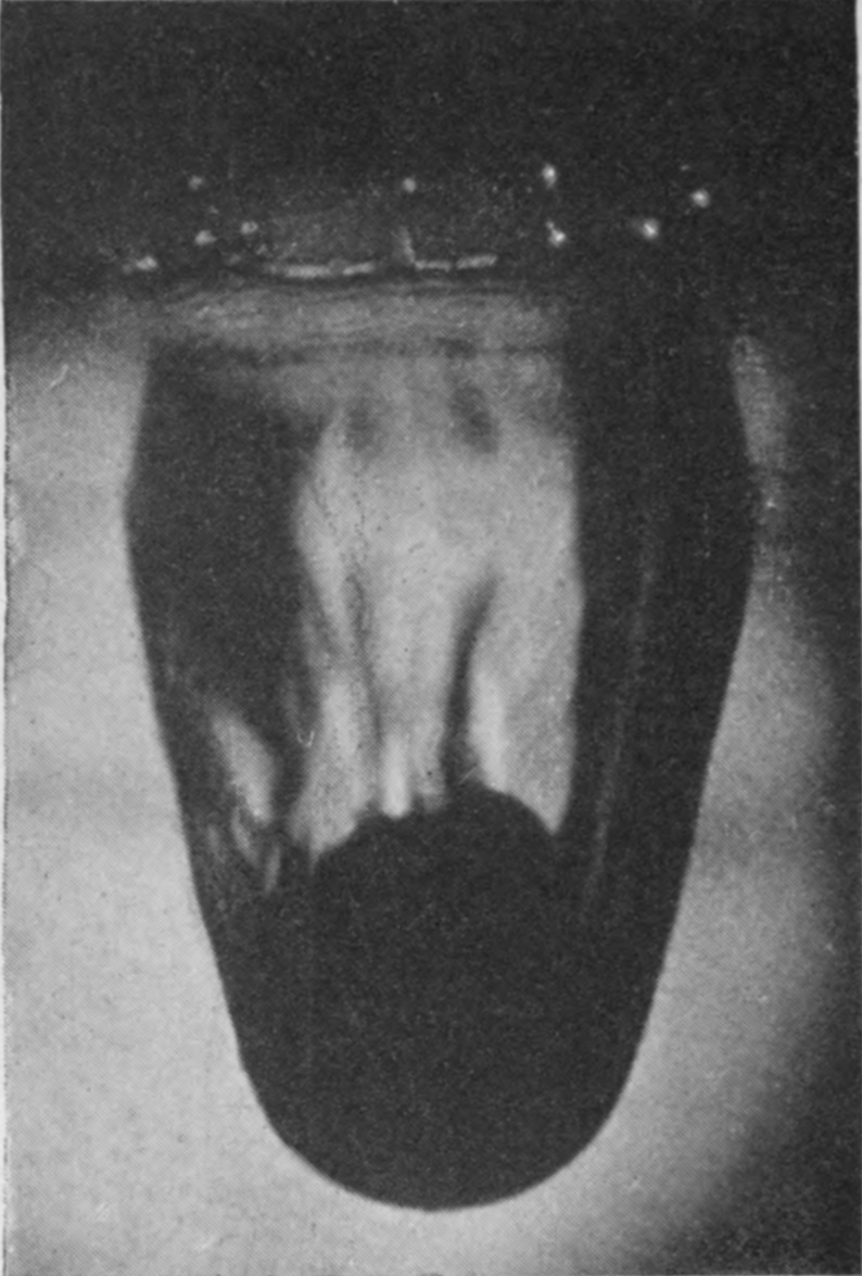 3 0·018 sec. — The sphere hangs at the bottom of a deepening pocket of air, its upper part unwetted, while the beaded crater lip shows out of focus above.